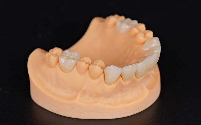 Yucera ST Multilayer — примеры реставраций