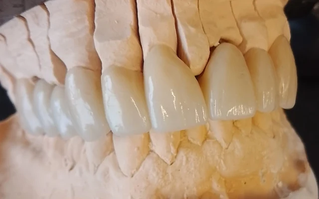 Yucera UT Multilayer — примеры реставраций
