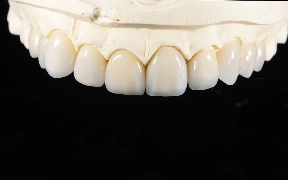 Yucera HT White — примеры реставраций